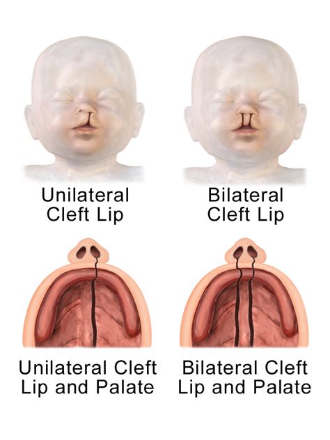 cleft lip and palate wikipedia