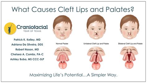 cleft palate associated conditions