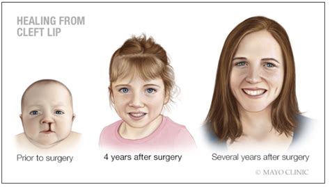 cleft palate mayo clinic