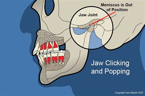 Clicking Ear Tmj