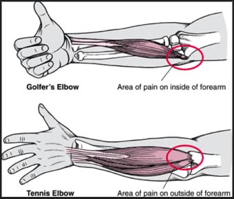 Climber Elbow Injuries