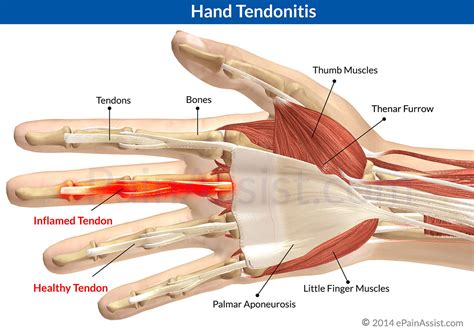 Climbing Tendonitis Finger