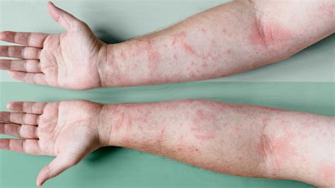 Clindamycin For Atopic Dermatitis