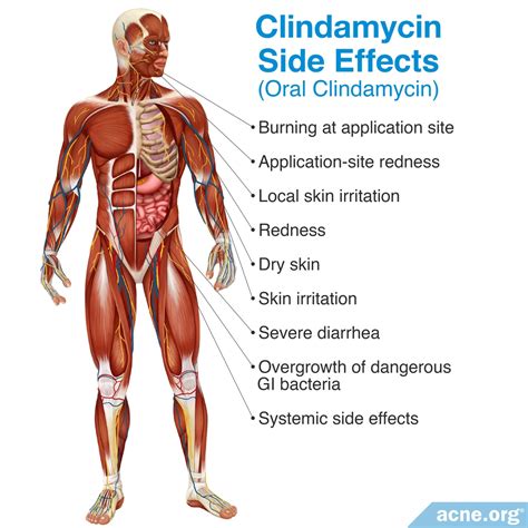 Understanding Clindamycin Side Effects: What You Need to Know Before Taking This Antibiotic