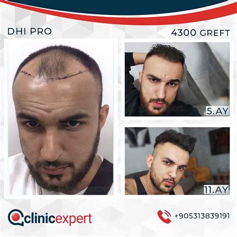 clinic expert hair transplant