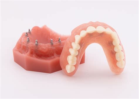 Clip On Dental Implants