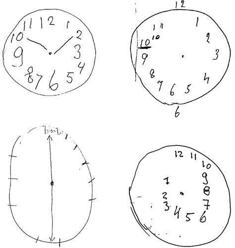 Clock Drawing And Dementia