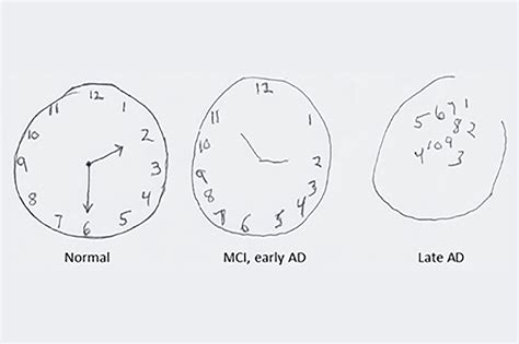 clock drawing test stroke