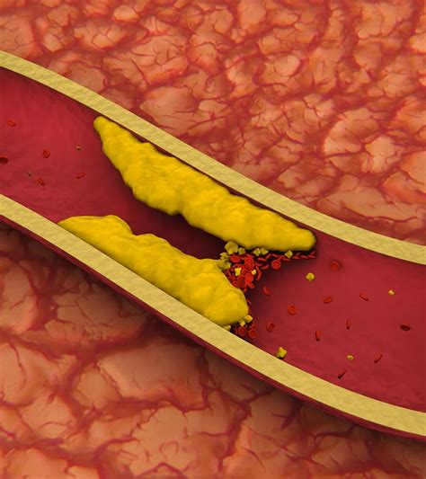 Blood Clots After Labor: What New Moms Need to Know About Risks and Symptoms