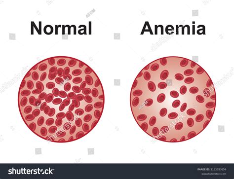 Cloves And Anemia