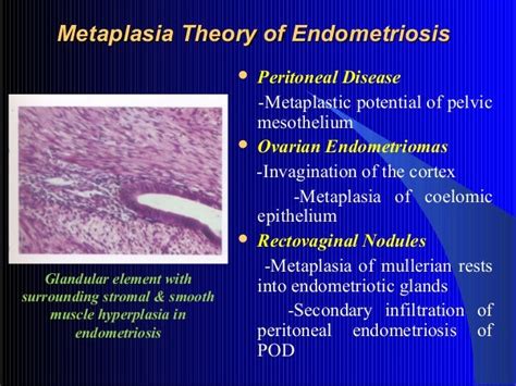 coelomic metaplasia theory of endometriosis