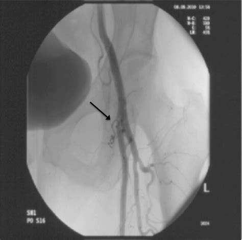 Coil Embolization Of Branch