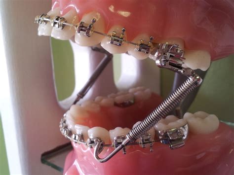Coil With Braces