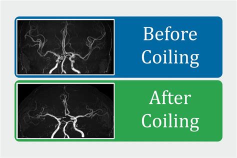 Coiling Brain Aneurysm Recovery