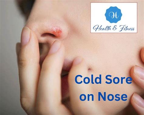 Cold Sore Around Nose: Causes, Symptoms, and Effective Treatments