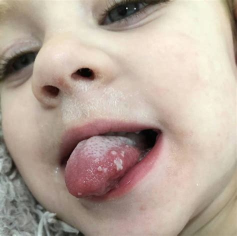 Protecting Infants from the Cold Sore Virus: What Parents Need to Know