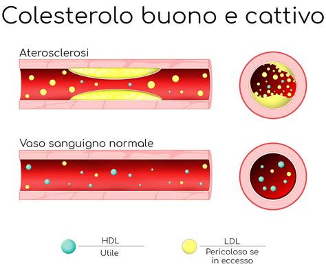 colesterolo ldl calcolo e interpretazione