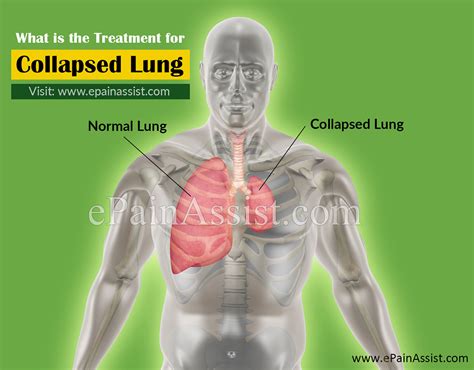 Collapsed Lung Treatment: Expert Care for Rapid Recovery