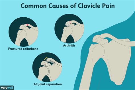 collarbone pain
