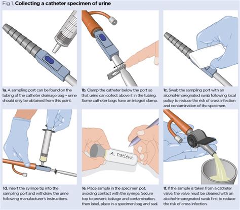 collecting urine sample from catheter