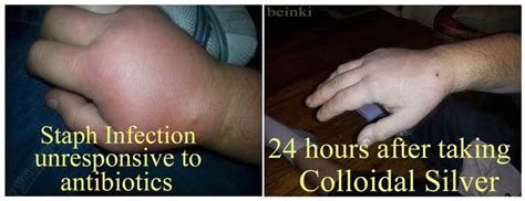 Colloidal Silver Staph Reddit