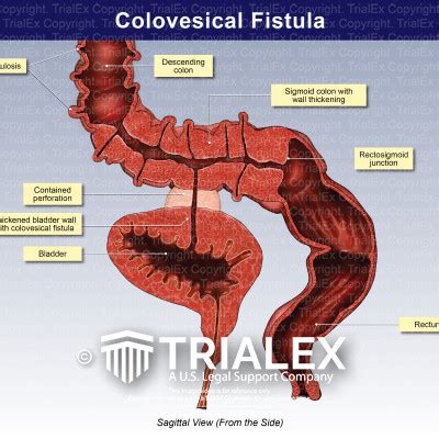 colo colonic fistula