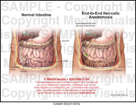 colocolonic anastomosis cpt code