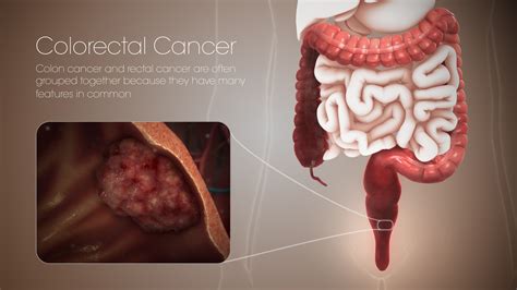 colon and colorectal cancer