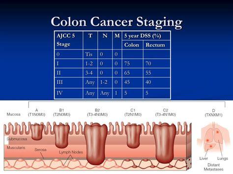 colon cancer staging