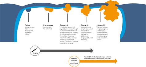 colon cancer therapy stages