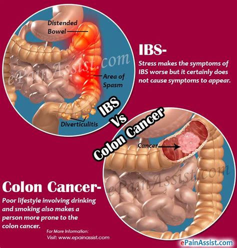 colon cancer vs ibs