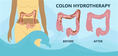 colon hydrotherapy diet