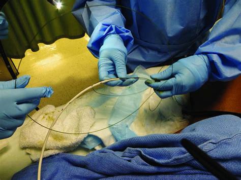 Colonoscopic Decompression Procedure