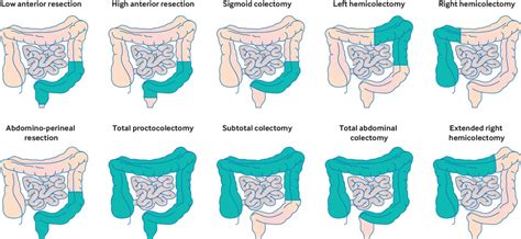 colorectal anastomosis cpt code