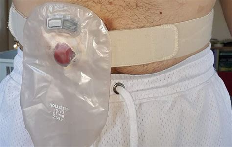 Colostomy Bag Use For