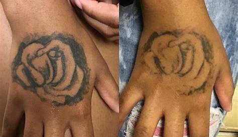 Colour Tattoo Removal Dark Skin Purple Ink On 9 Stylish Black People