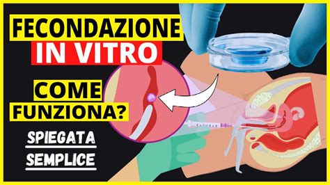 come avviene la fecondazione in vitro