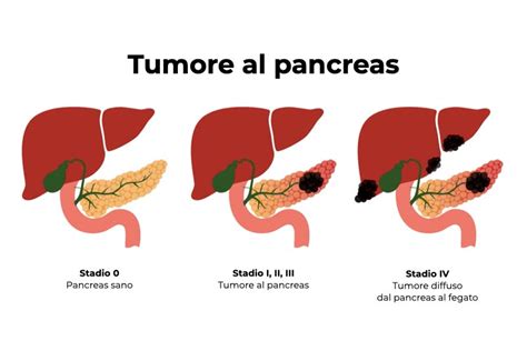 come si manifesta il tumore al pancreas