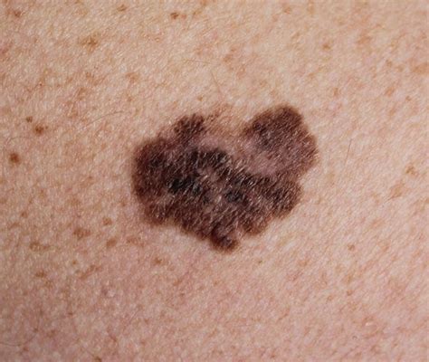come si riconosce un melanoma