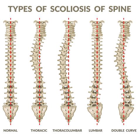 common causes of spinal deformities