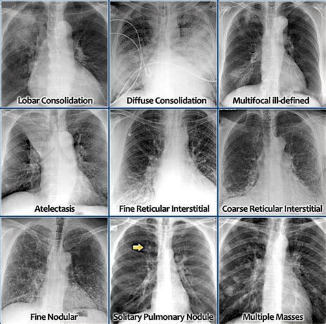Common Chest X-Ray Abnormalities Uncovered
