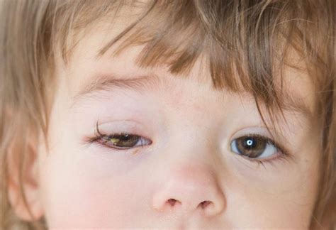 common eye conditions in infants