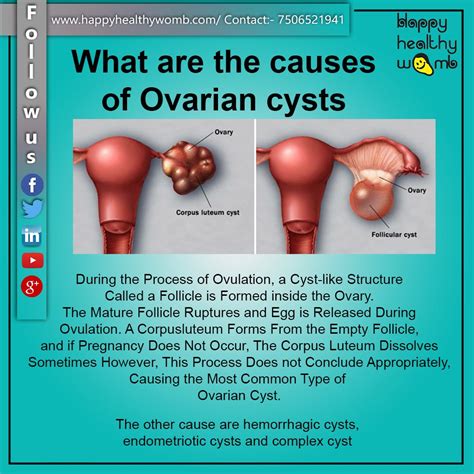 common symptoms of ovarian cysts