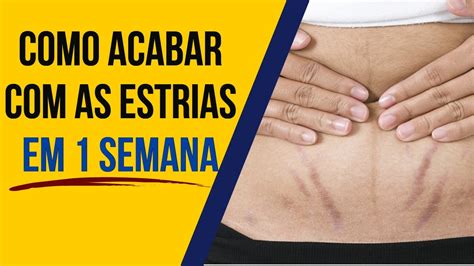 como acabar con las estrias