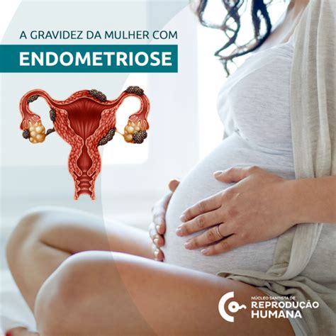como engravidar com endometriose