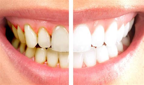 como evitar manchas nos dentes