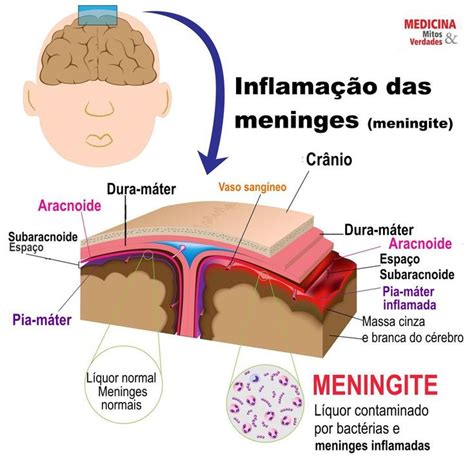 como surge a meningite