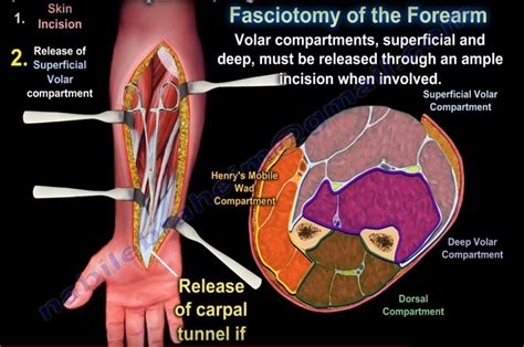 Compartment Release Of Forearm