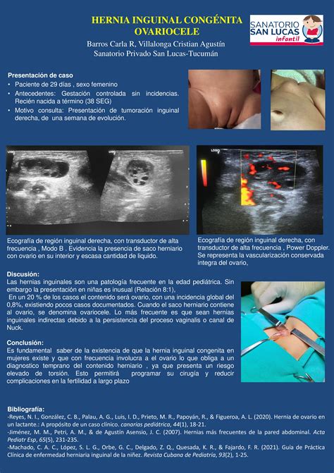 compendio de radiologia hernia inguinal