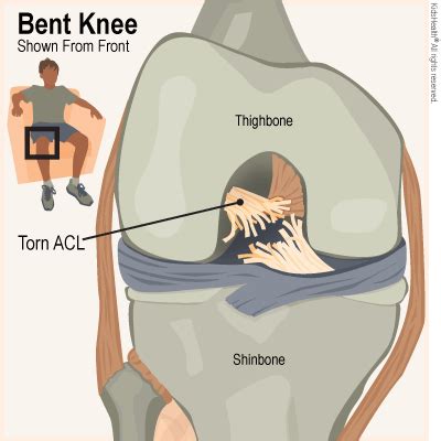 complete acl tear picture